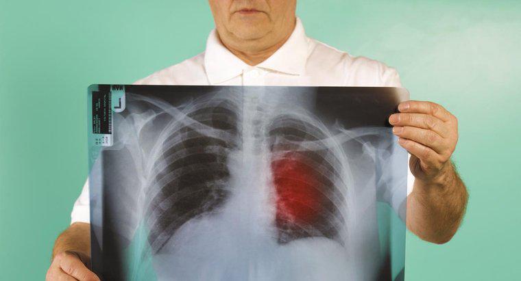 ¿Cuál es el pronóstico para el cáncer de pulmón en estadio tres?
