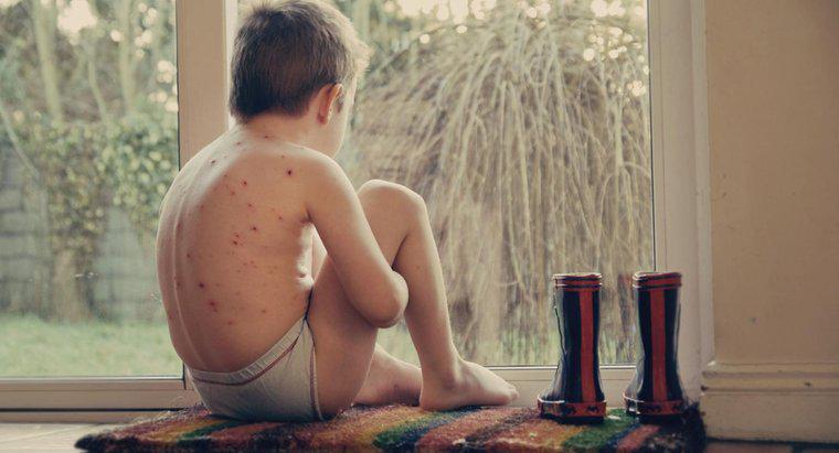 ¿Cuál es el ciclo de vida de la varicela?