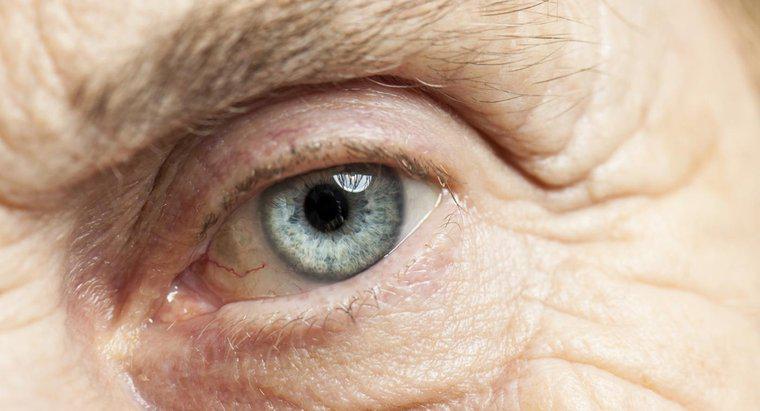 ¿Qué se puede esperar de su vista inmediatamente después de la cirugía de cataratas?
