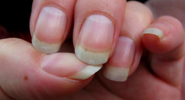 ¿Qué causa las crestas en las uñas?