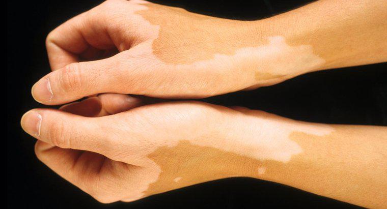 ¿Qué hace que aparezcan manchas de luz en la piel?