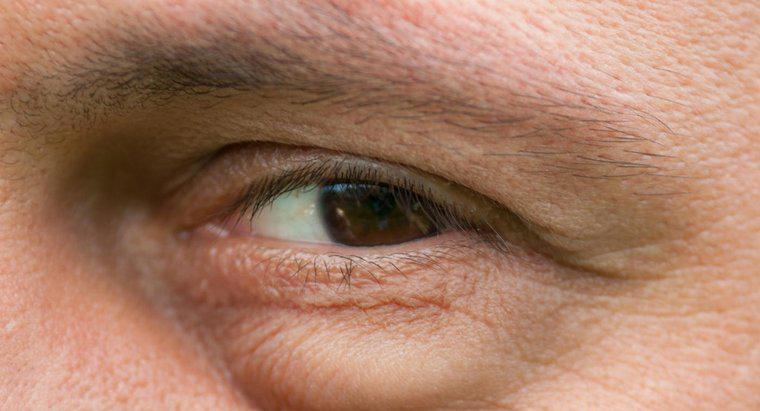 ¿Cuáles son las posibles causas de hinchazón debajo de los ojos?