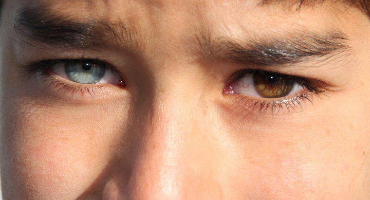 ¿Qué tan raro es la heterocromia en los humanos?