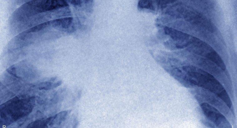 ¿Qué es el linfoma de los pulmones?