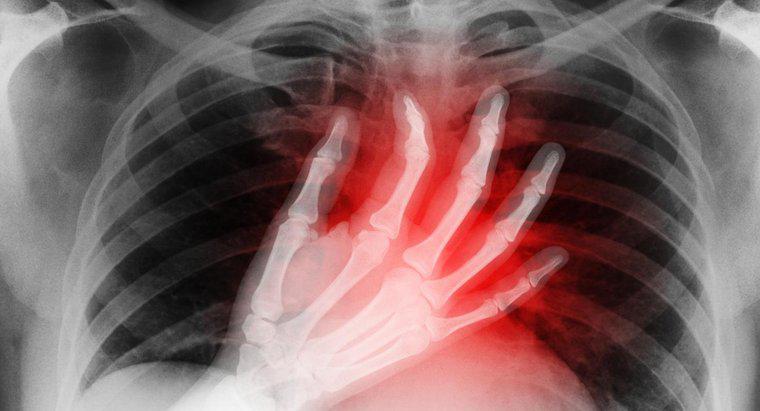 ¿Cuáles son los síntomas de un mini ataque al corazón?