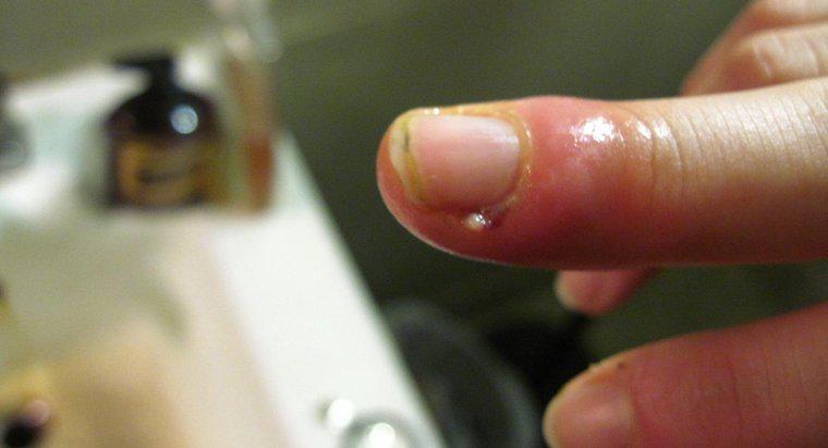 ¿Qué debe hacer una persona con un dedo hinchado por una infección de cutícula?