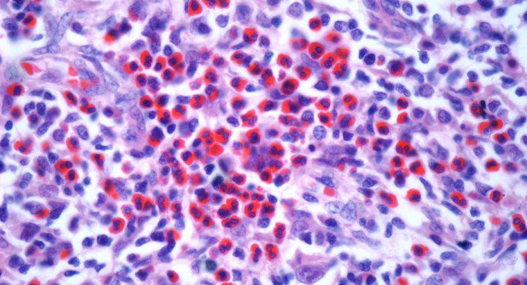 ¿Qué es el cáncer de linfoma en estadio 3?