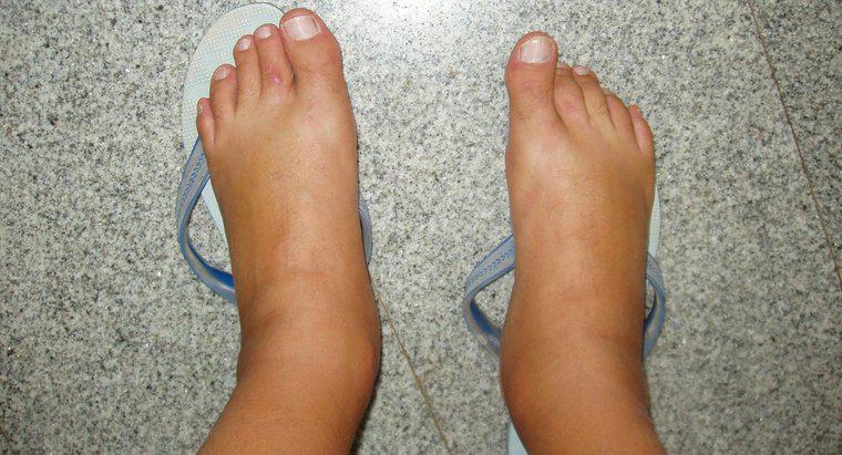 ¿Cuáles son las causas de los pies hinchados?