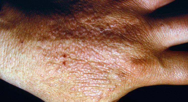 ¿Cómo las personas contraen dermatitis?