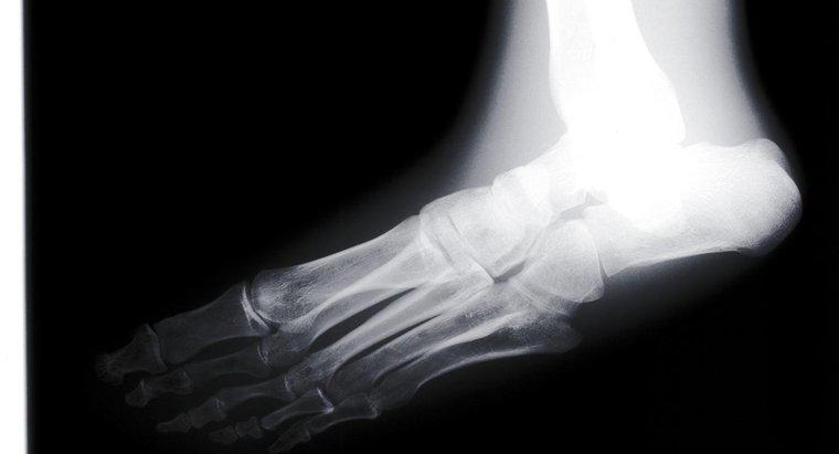 ¿Cómo se puede arreglar los pies planos con tratamiento?