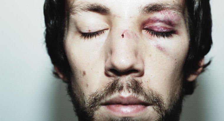 ¿Cómo te haces heridas en la cara para curarte más rápido?