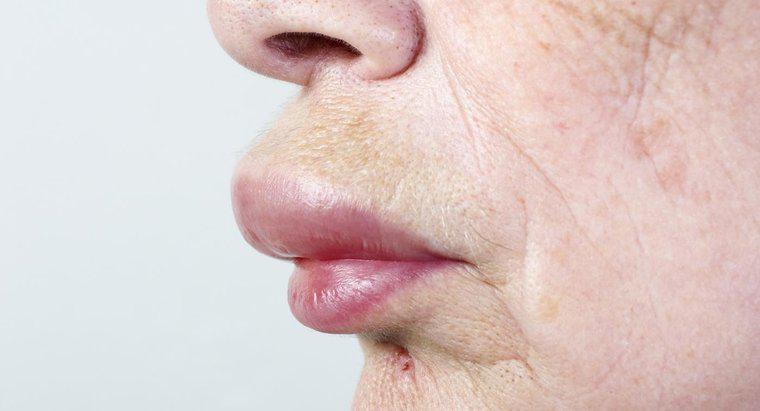 ¿Cómo se cura un labio y una cara hinchados?