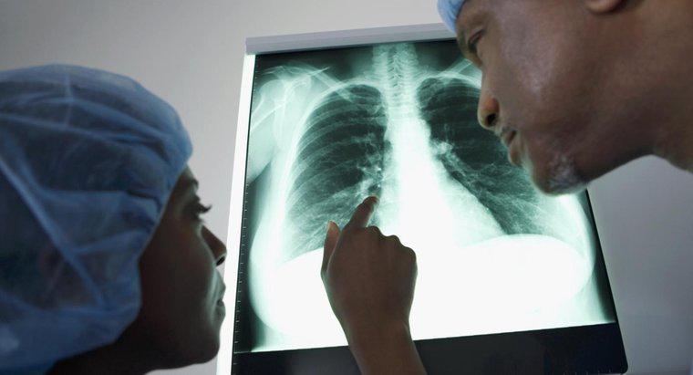 ¿Cuáles son las diferentes opciones de tratamiento para el líquido en los pulmones?