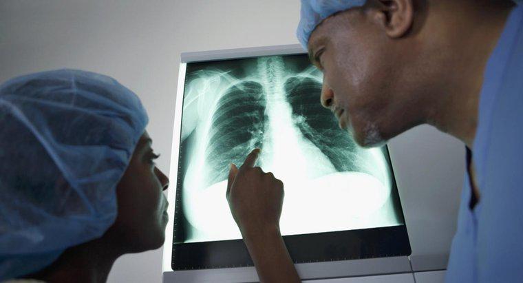 ¿Qué significa una misa en el pulmón?