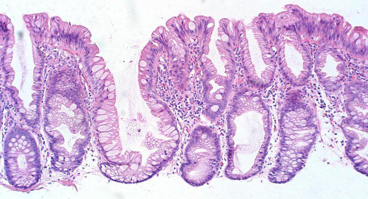 ¿Qué causa los pólipos de colon?