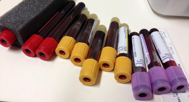¿Qué miden los niveles de ferritina en un análisis de sangre?