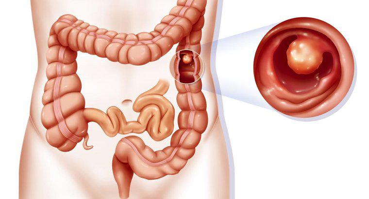 ¿Qué causa un bloqueo de colon?
