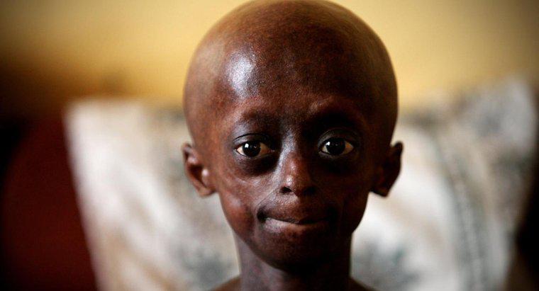 ¿Qué limitaciones tiene una persona con progeria?