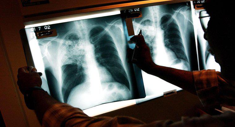 ¿Cuáles son los efectos a largo plazo de la tuberculosis?