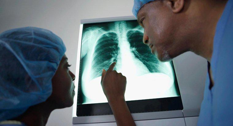 ¿Qué síntomas son únicos al cáncer de pulmón?