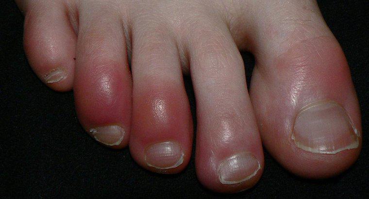 ¿Los dedos rojos son un síntoma del síndrome de Raynaud?