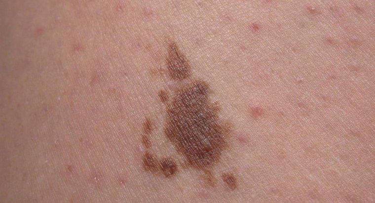¿Qué son las manchas solares en la piel?