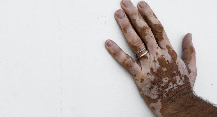 ¿Cómo deshacerse de la decoloración de la piel?