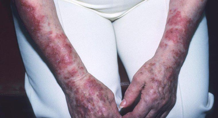¿Cómo se propaga el lupus?