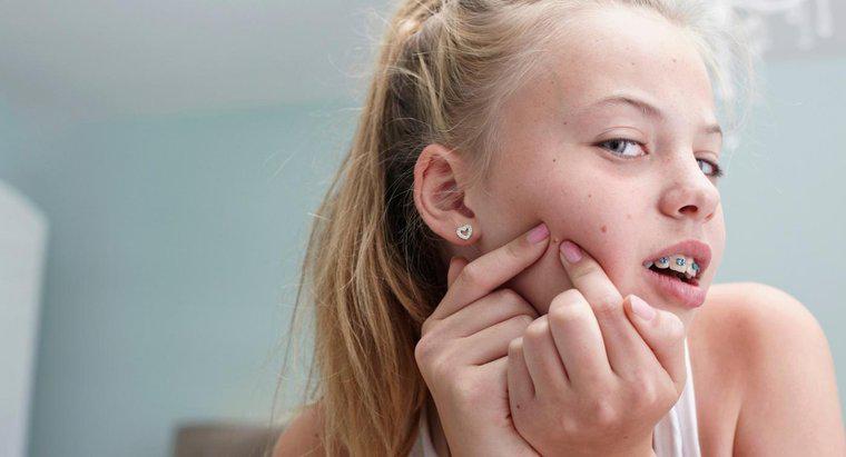 ¿Cómo deshacerse del acné?