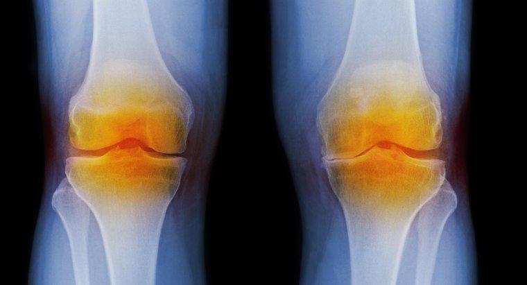 ¿Cuáles son los síntomas de la artritis en la rodilla?