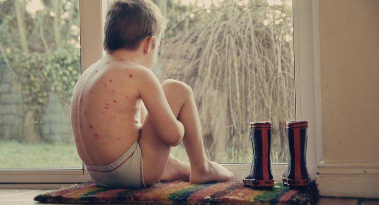 ¿A qué parte del cuerpo afecta la varicela?