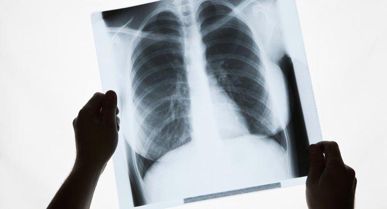 ¿Qué causa las manchas blancas en los pulmones?