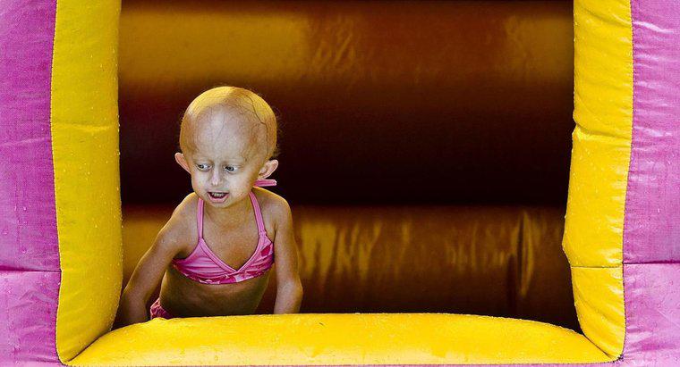 ¿Cuánto tiempo puede vivir con la progeria?