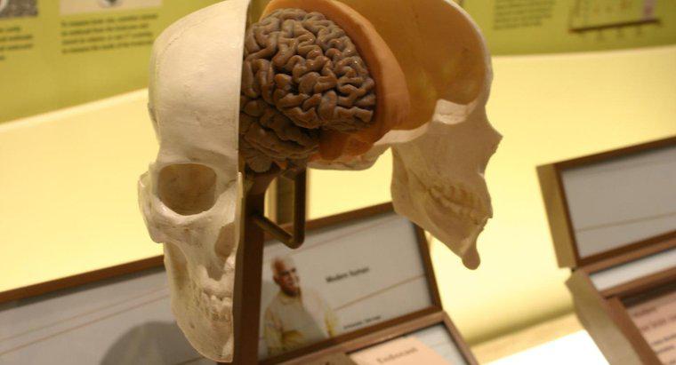 ¿Qué indican los ventrículos cerebrales agrandados?