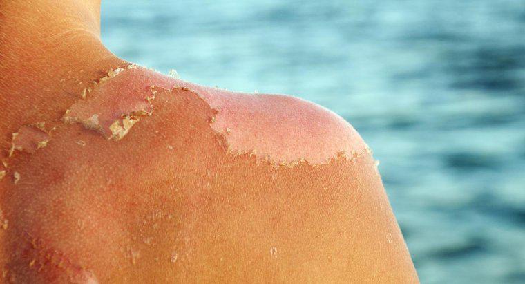 ¿Cómo tratar una quemadura de sol peeling?