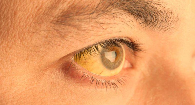 ¿Qué causa que la piel debajo de los ojos se vuelva amarilla?