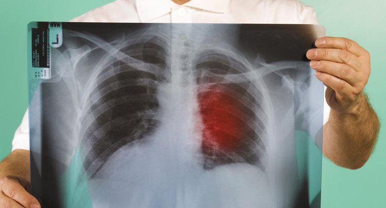 ¿Cuáles son los primeros signos de cáncer de pulmón?