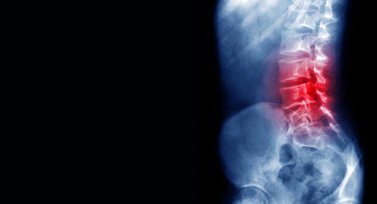 ¿Cuáles son las causas para el dolor de espalda baja?