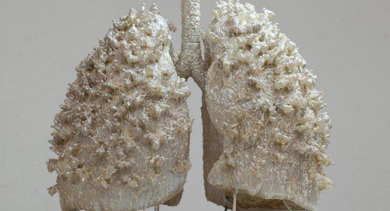 ¿Puede una persona vivir con un pulmón?
