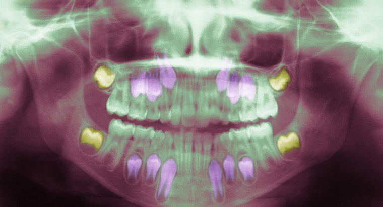 ¿Qué causa una infección del diente de sabiduría?